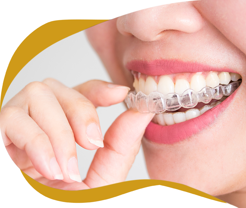 clear teeth aligners