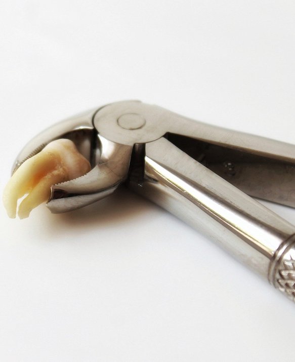 Wisdom Tooth Surgery | Root Canal Treatment | Toothache Molar Singapore | Gum Swelling Singapore