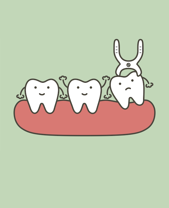 Wisdom Tooth Surgery in Singapore