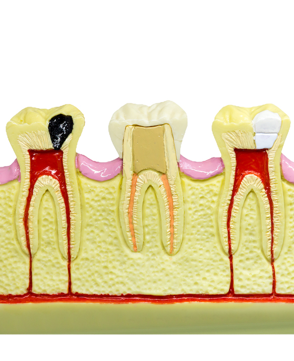 root canal therapy | endodontic surgery