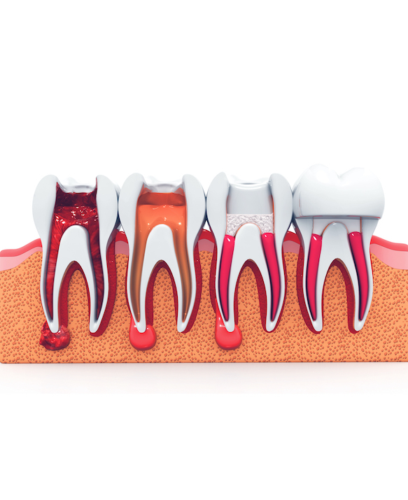 Root Canal Treatment in Singapore