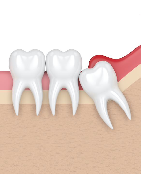 Wisdom Tooth Surgery | Root Canal Treatment | Toothache Molar Singapore | Gum Swelling Singapore