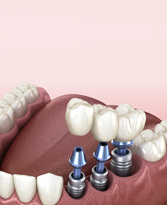 affordable dental implants