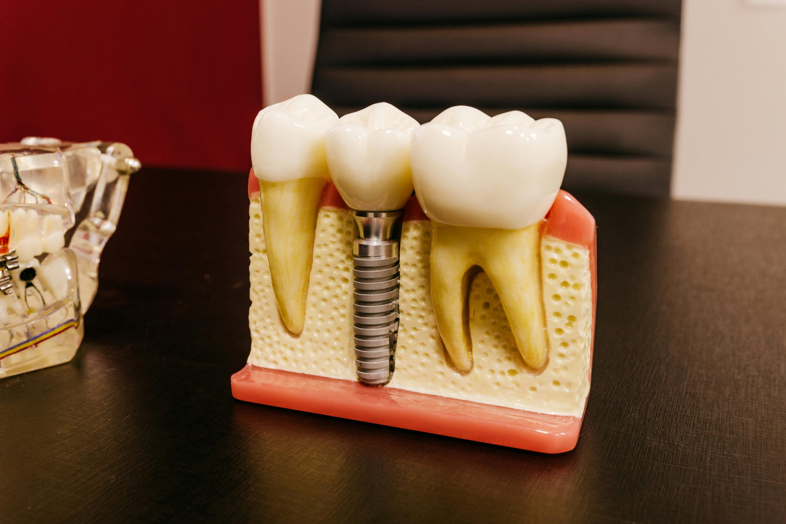 Model showing a dental implant with a crown replacing a tooth in the jawbone