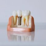 A cross-section model showing a dental implant