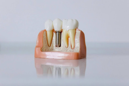 A cross-section model showing a dental implant