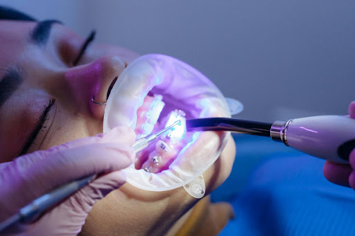 A dentist using a UV curing light and a dental probe on a patient's ceramic braces