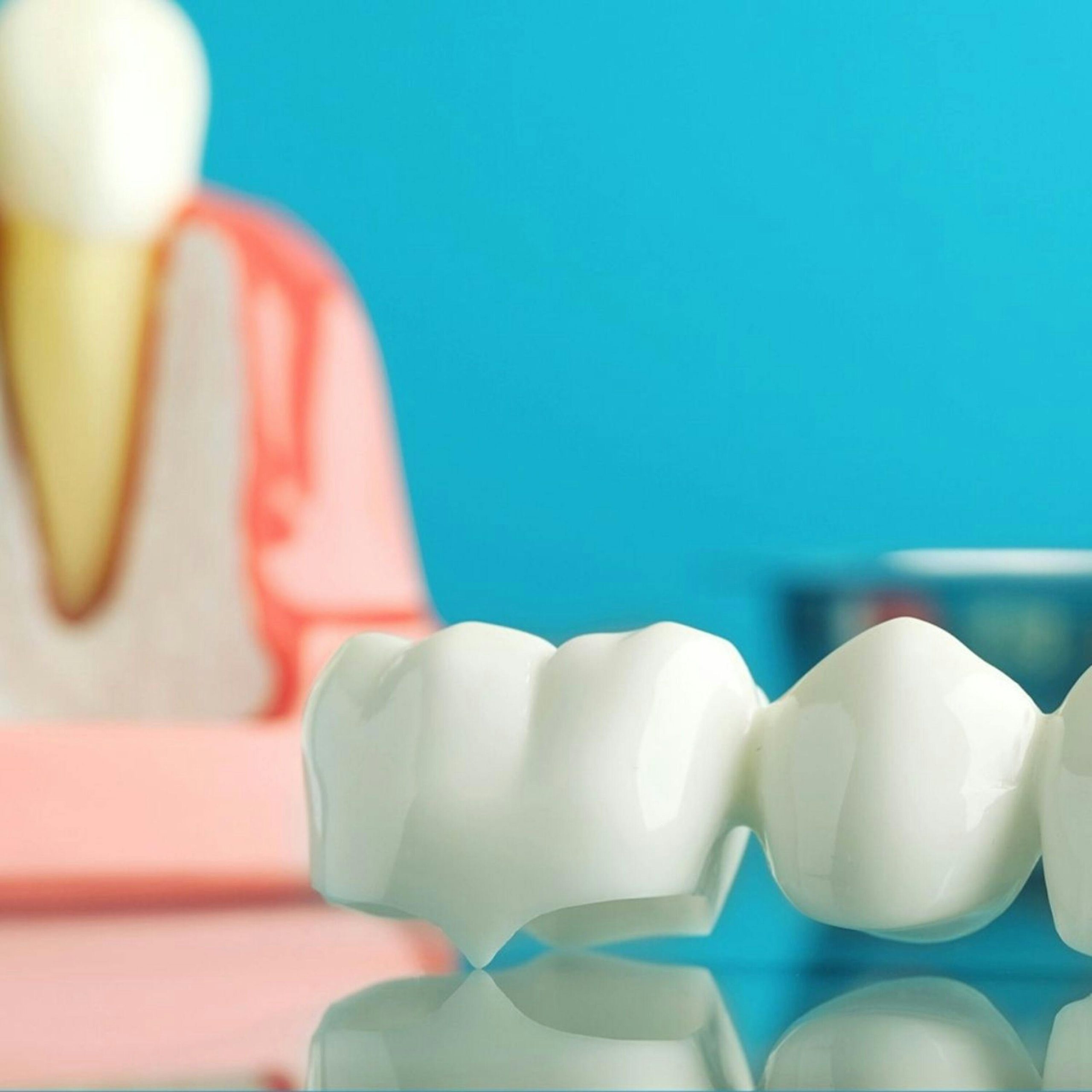 A ceramic three-unit dental bridge restoration